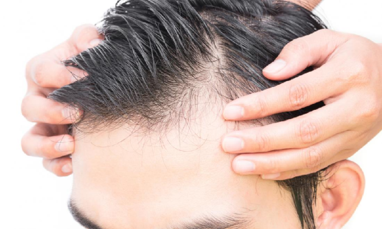 All you need to know about hair loss treatment for men ...