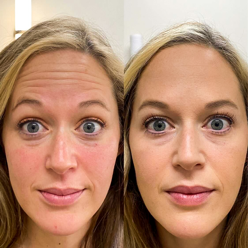 Botox: Before And After - Vert X Health