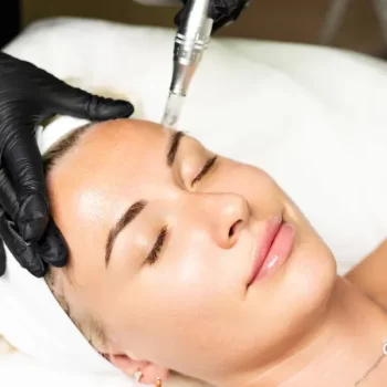 Acne Scar Treatment